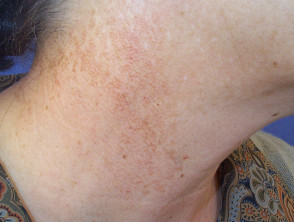 Skin affected by poikiloderma of Civatte